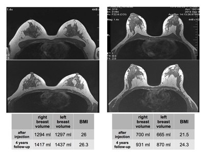 Lipofilling, Expanded Stem Cells Are a Valuable Alternative to Breast Implants