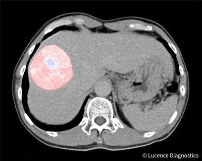 Lucence Diagnostics to Develop AI Tools for Liver Cancer Treatment