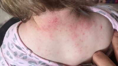 Mum Hails $10 Childs Farm Skincare Products "Life-changing" After They Clear Her Daughter's Severe Eczema