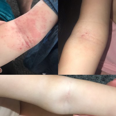 Mum Hails $10 Childs Farm Skincare Products "Life-changing" After They Clear Her Daughter's Severe Eczema