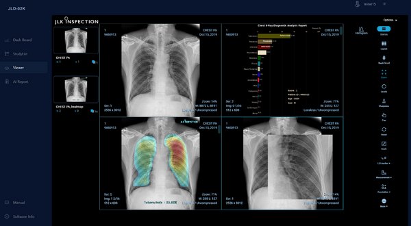 JLK Inspection has announced signing of a partnership with the National TB Center (NTC) and the Clinton Health Access Initiatives (CHAI) in Lao PDR to conduct a tuberculosis screening project