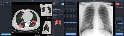 VUNO offers a suite of AI solutions in response to the COVID-19 outbreak: VUNO Med(R)- LungQuant(TM) and VUNO Med(R)-Chest X-ray(TM): COVID-19