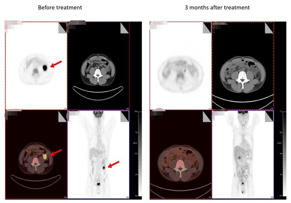 World's first clinical trial of non-viral PD1 specific targeted CAR T therapy achieves great breakthroughs