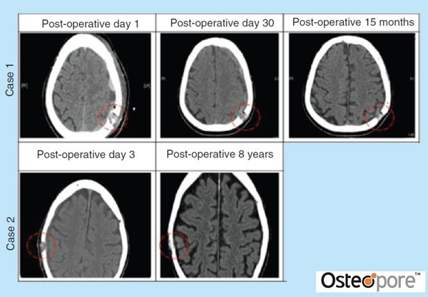 New Medical Findings From 10-year Study of 3D Printed Regenerative Implant Osteoplug