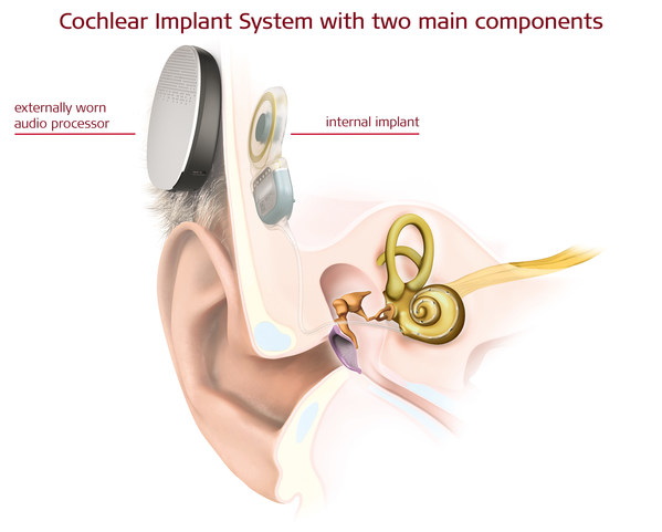 MED-EL: First Surgeries Ever in Europe with a Totally Implantable Cochlear Implant