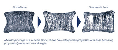 IOF: A Fracture Every 3 Seconds Worldwide - That's Osteoporosis