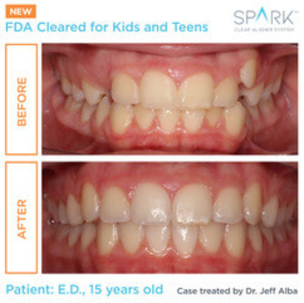 Spark™ Aligners Receive FDA Clearance For Orthodontic Treatment Of Kids, Giving Parents A New Option With Significant Treatment Advantages Over The Leading Competitor