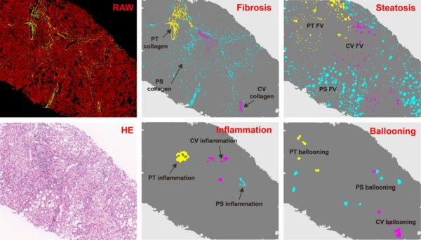 qFIBS Demonstrates Suitability for Nonalcoholic Steatohepatitis (NASH) Assessment in Clinical Trials and Patient Care with Full Quantification of All Crucial Histopathological Features