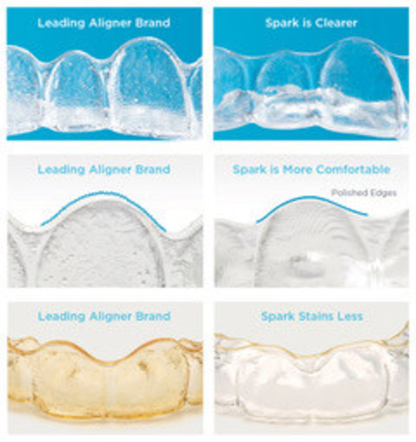 Spark™ Aligners Receive FDA Clearance For Orthodontic Treatment Of Kids, Giving Parents A New Option With Significant Treatment Advantages Over The Leading Competitor