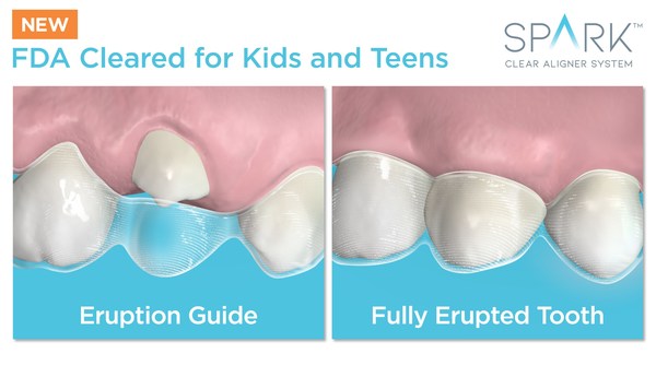 Spark™ Aligners Receive FDA Clearance For Orthodontic Treatment Of Kids, Giving Parents A New Option With Significant Treatment Advantages Over The Leading Competitor