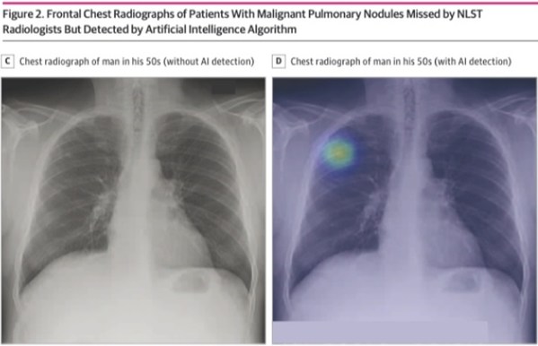 AI Analysis Can Improve Lung Cancer Detection on Chest Radiographs