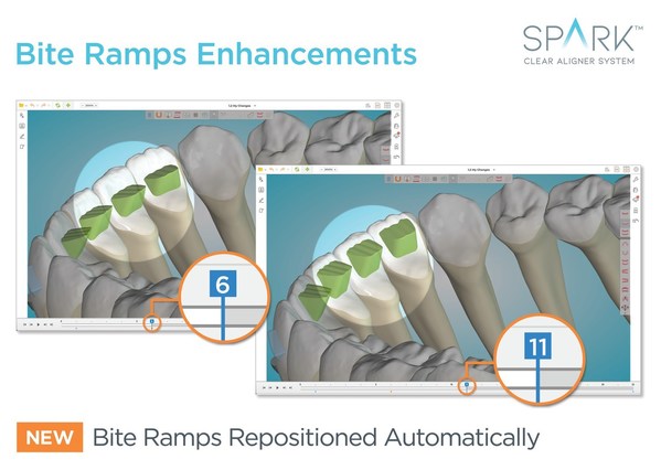 SPARK™ CLEAR ALIGNERS NEW RELEASE 12 GIVES DOCTORS MORE CONTROL, FLEXIBILITY AND EFFICIENCY IN CASE SETUP AND TREATMENT PLANNING