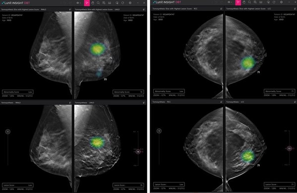 Lunit to Participate in RSNA 2021, Presenting its New AI Solutions for Digital Breast Tomosynthesis and Chest CT