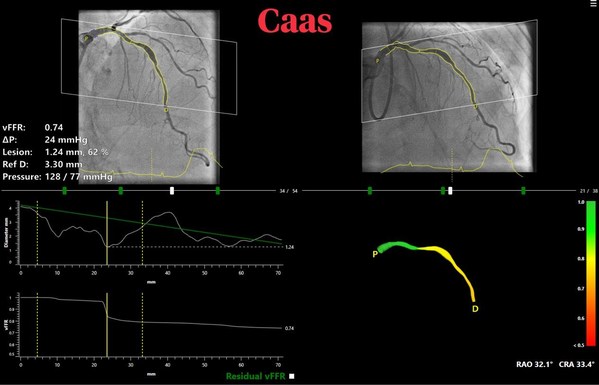 The innovative software "CAAS vFFR" by Pie Medical Imaging for the non-invasive physiological assessment of intermediate coronary lesions is the subject of FAST III, a  multicenter European clinical trial which will investigate the effectiveness