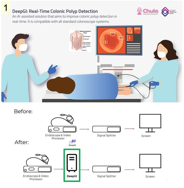 DeepGI AI - A Thai Innovation for the Precision in Colorectal Polyp Detection