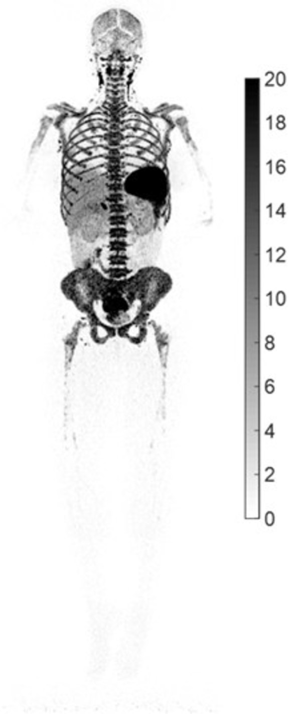 UC Davis' new research shows how total-body PET imaging can assess the immunological response to COVID-19 infections