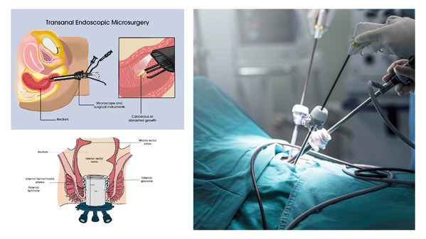 Dr Aaron Poh shares Advanced Surgical Techniques for Colorectal Cancer, the Top 3 Most Common Cancer Worldwide