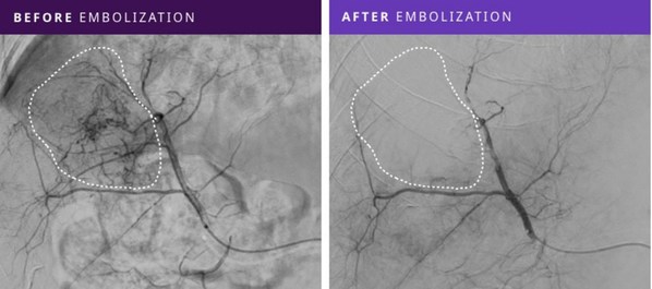 Instylla First-In-Human Clinical Trial Published Results Demonstrate Technical Success and Persistent Embolization Across All Patients