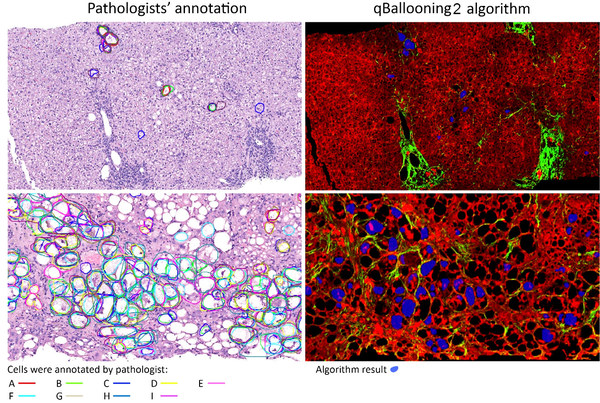 HistoIndex and Global Liver Experts Advance Stain-free AI Quantification of Hepatocyte Ballooning as a Reproducible Approach and Potential Endpoint for NASH Clinical Trials