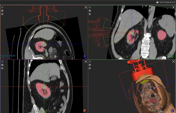 HistoSonics Announces FDA Approval of its Pivotal IDE #HOPE4KIDNEY Trial