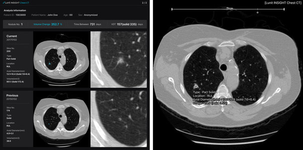 Lunit to Participate in RSNA 2021, Presenting its New AI Solutions for Digital Breast Tomosynthesis and Chest CT