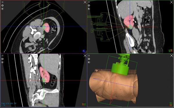 HistoSonics Announces First Ever Kidney Tumor Treatment Using Histotripsy