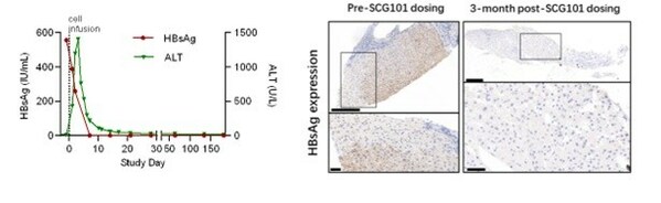 ISCT 2023: Late-breaking SCG101 Data Show 100% HBsAg+ Hepatocyte Eradication and 74.5% HCC Tumour Reduction With Single Dose HBsAg-specific TCR-T Cell Therapy