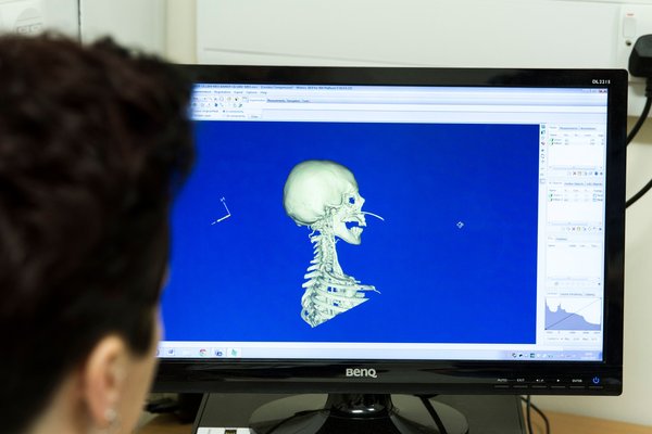 Thai Patients to Benefit From 3D Preoperative Planning