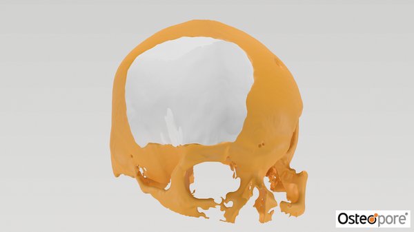 World's First 3D Regenerative Implant and Regenerative Surgical Technique To Regrow Man's Skull