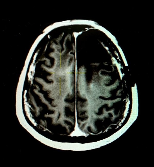 NaviFUS Launches Neuronavigation-guided Clinical Trial to Open the Blood-Brain-Barrier for Combination FUS-Bevacizumab Therapy in rGBM Patients