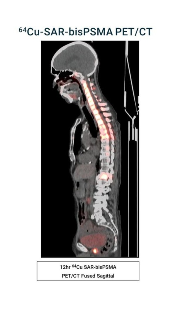 Recruitment for the dosimetry phase of Clarity's Cu-64/Cu-67 SAR-bisPSMA theranostic prostate cancer trial completed