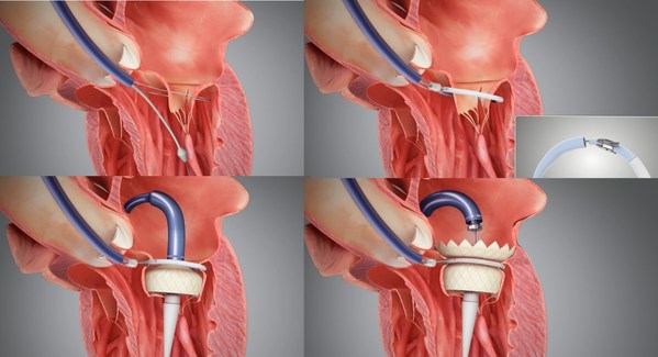 Peijia Medical's New Milestone Asia's first successful clinical case using HighLife transseptal mitral valve replacement technology