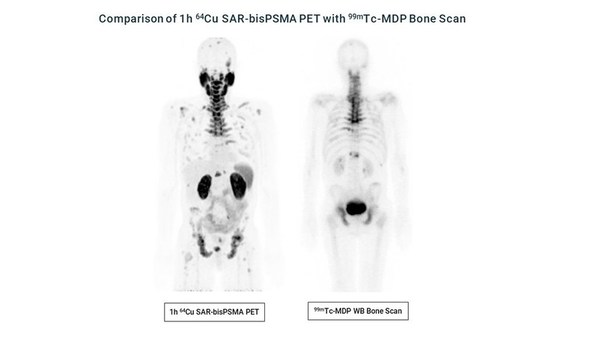 Recruitment for the dosimetry phase of Clarity's Cu-64/Cu-67 SAR-bisPSMA theranostic prostate cancer trial completed