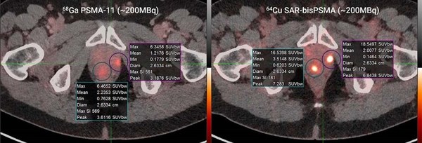 Fifty percent recruitment milestone for PROPELLER prostate cancer trial