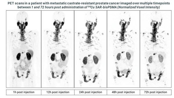 Recruitment for the dosimetry phase of Clarity's Cu-64/Cu-67 SAR-bisPSMA theranostic prostate cancer trial completed