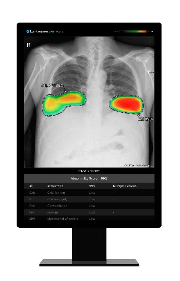 Lunit AI Can Help Tuberculosis Screening in Prisons, as Published in The Lancet Regional Health - Americas