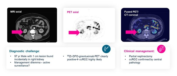 Detailed Results from Telix's ZIRCON Phase III Kidney Cancer Imaging Study Presented at ASCO GU