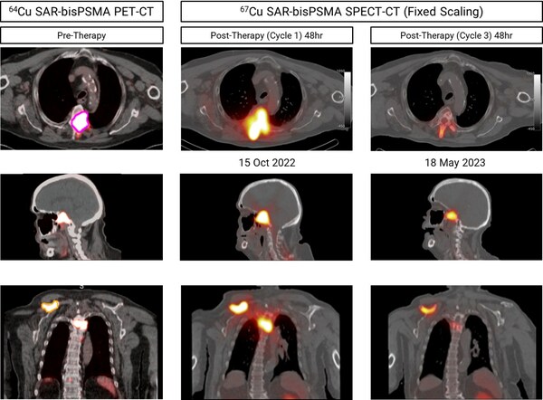 Clarity's theranostic prostate cancer trial advances to cohort 2